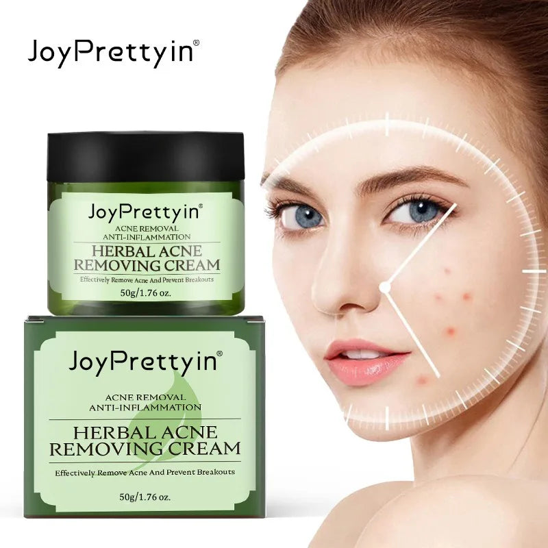 Natural Moisturizing Acne Treatment Cream