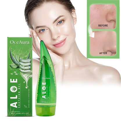 Aloe Vera Gel Moisturizing Acne Treatment