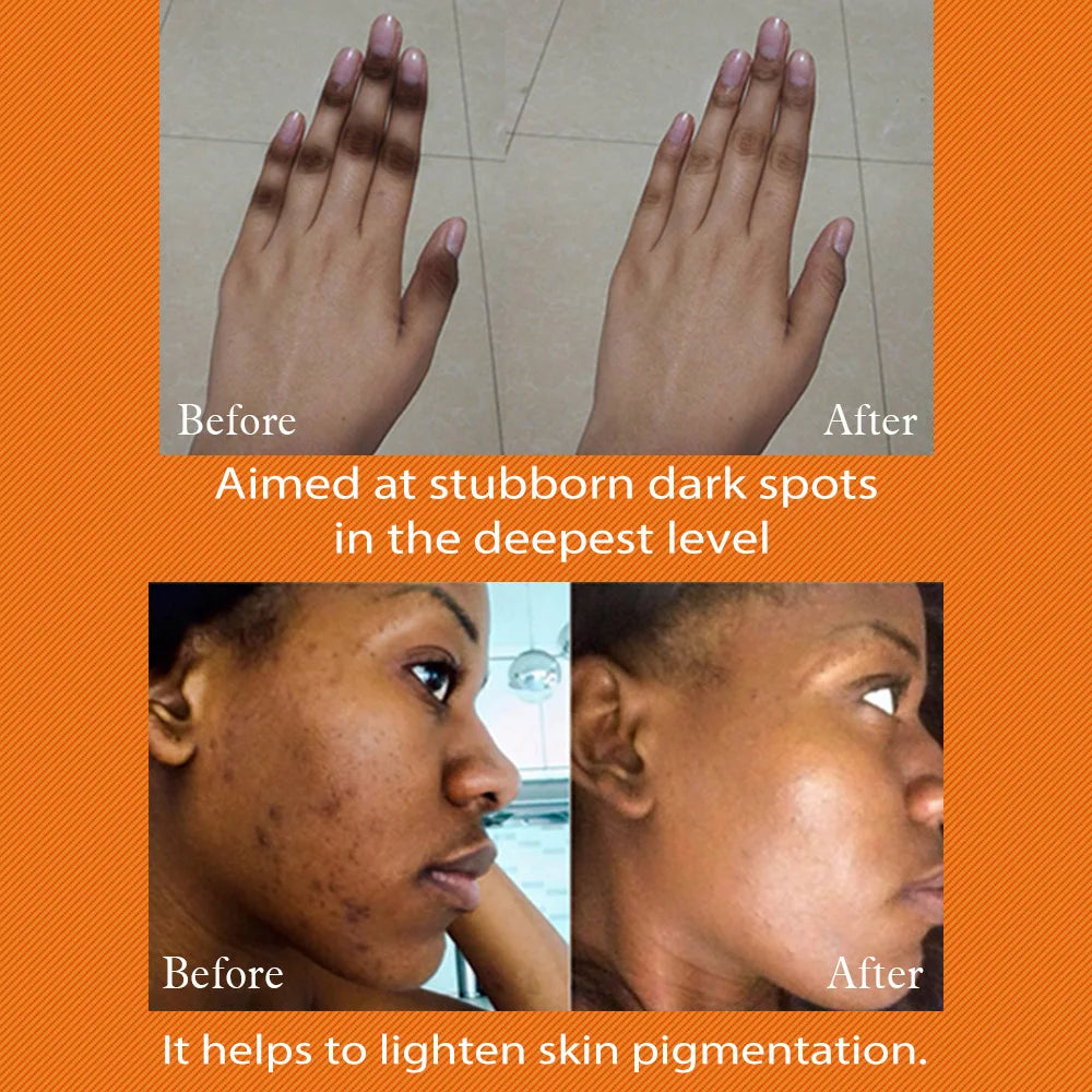 AILKE Dark Spot Remover for Underarms and Body